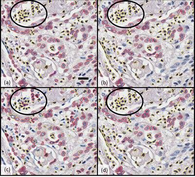 Digital quantitative tissue image analysis of hypoxia in resected pancreatic ductal adenocarcinomas
